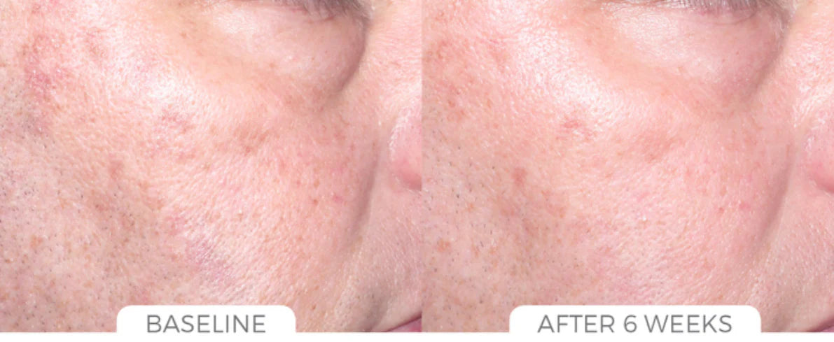 ENSEMBLE ÉCLAIRCISSANT POUR HYPERPIGMENTATION